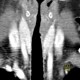 Wegener's granulomatosis of trachea: CT - Computed tomography